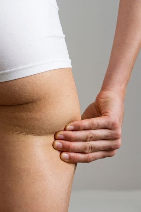 Main pressant l'arrière de la cuisse pour montrer la peau d'orange